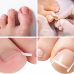 Paski ochronne na wrastające paznokcie N92 (10szt.) - obrazek 3